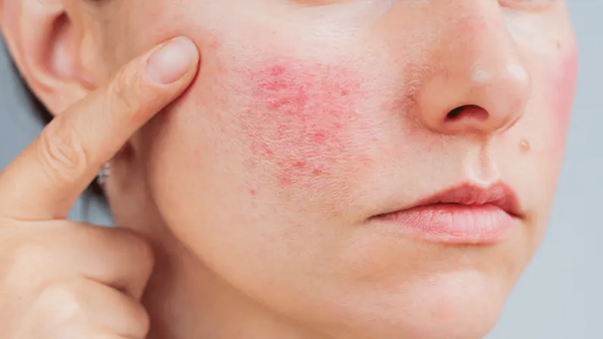 Eczema: A Pharmacist’s Guide to Skincare and Managing Flare-Ups - French Beauty Co.
