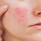 Eczema: A Pharmacist’s Guide to Skincare and Managing Flare-Ups