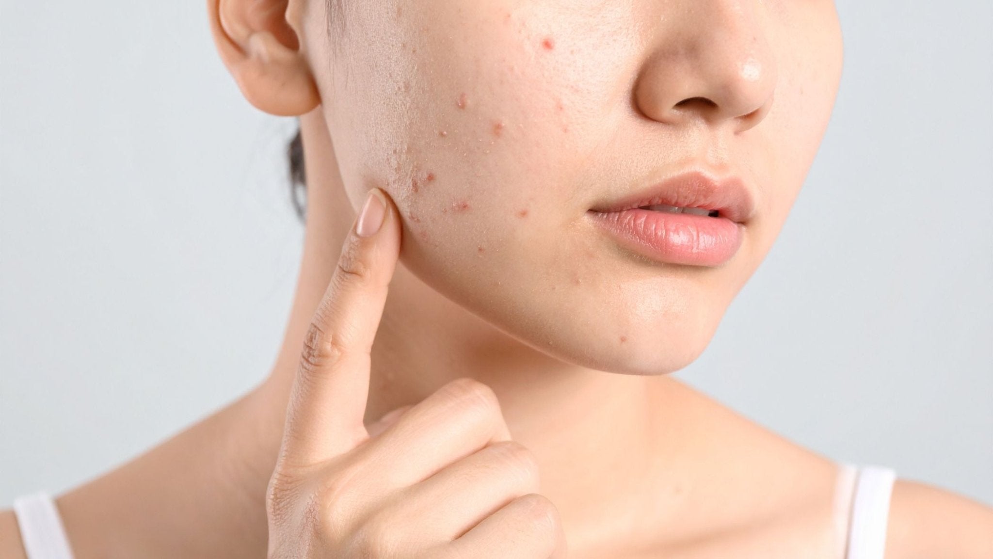 Treating Acne: The French Beauty Co Way - French Beauty Co.