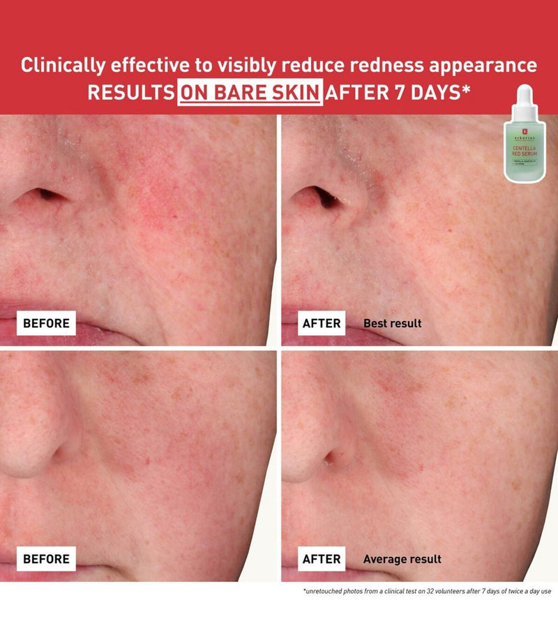 Centella Red Serum 30ml, Erborian, French Beauty Co before after