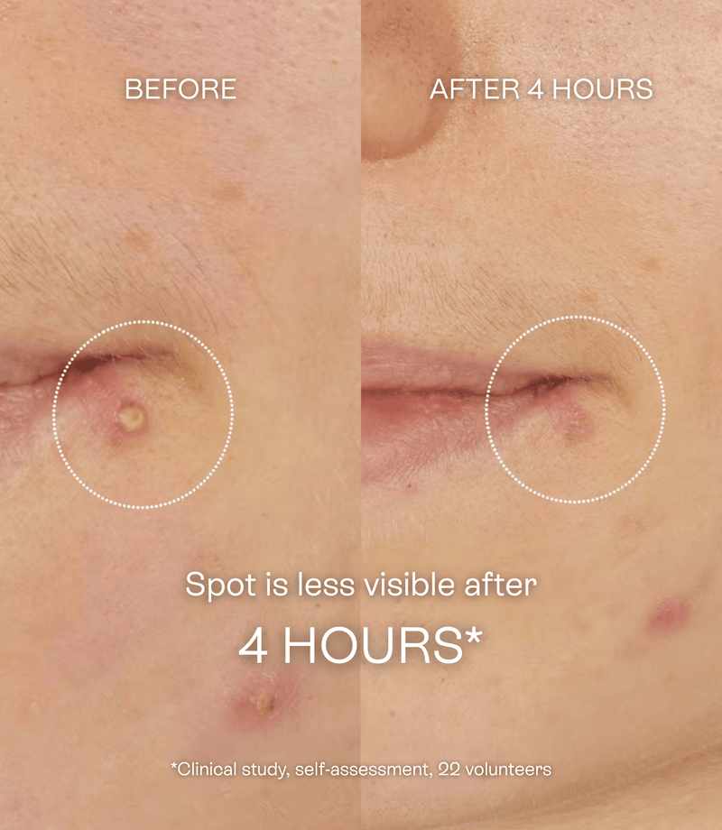 Vinopure Salicylic Spot Solution 15ml - French Beauty Co.Caudalie